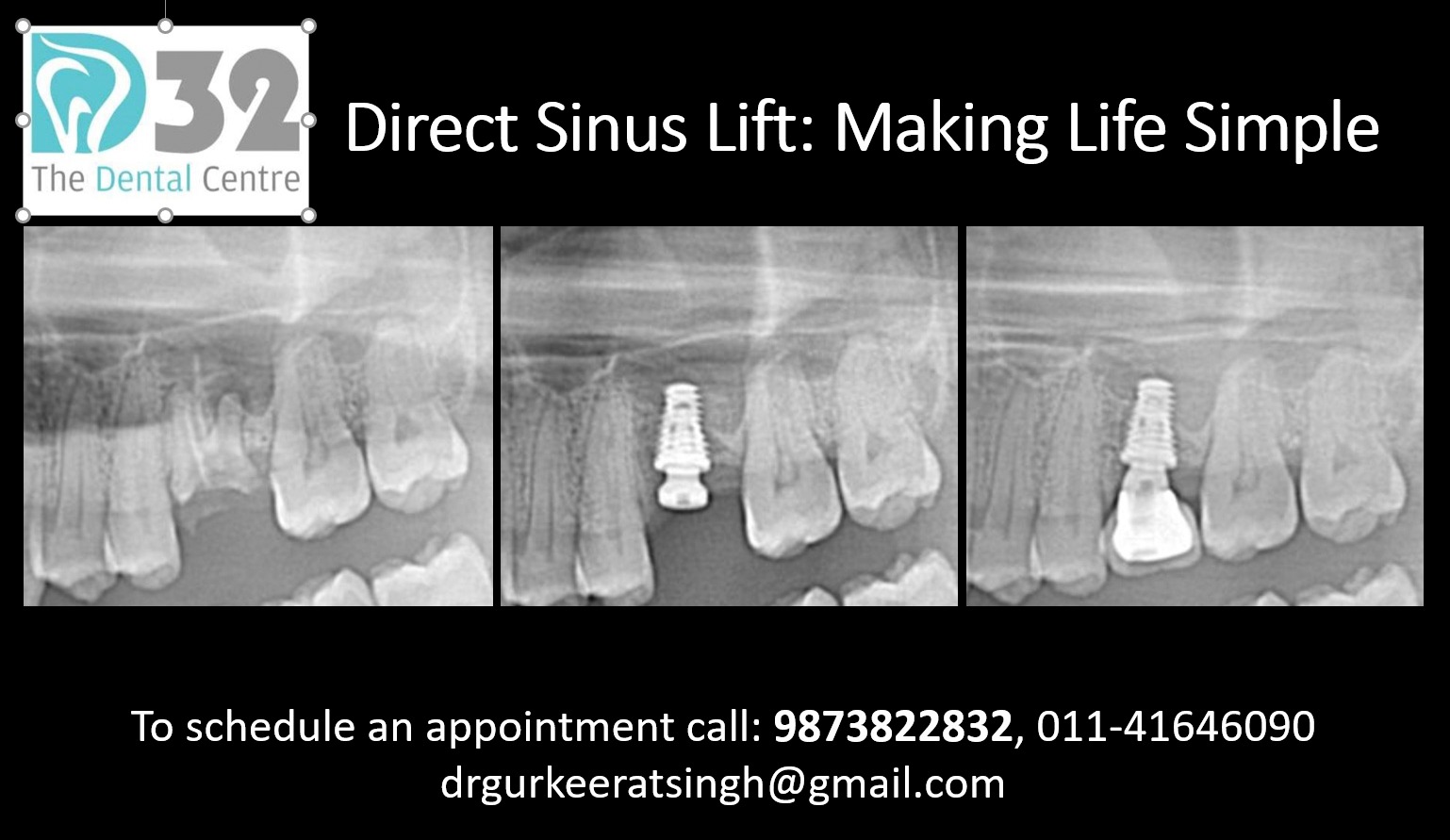 Direct Sinus Lift: Making Life Simple
