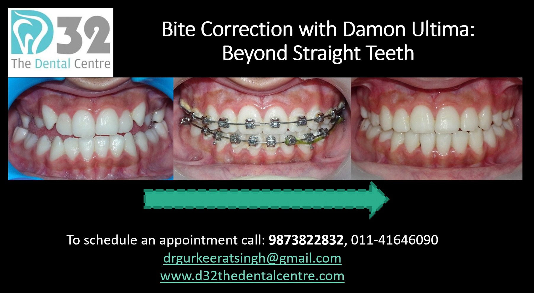 Bite Correction with Damon Ultima: Beyond Straight Teeth