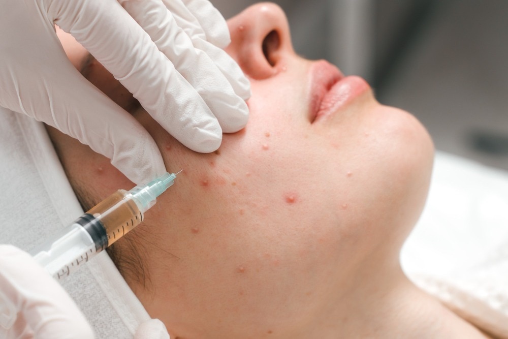 Acne Treatment near Panvel Dermatologist for Active Breakouts