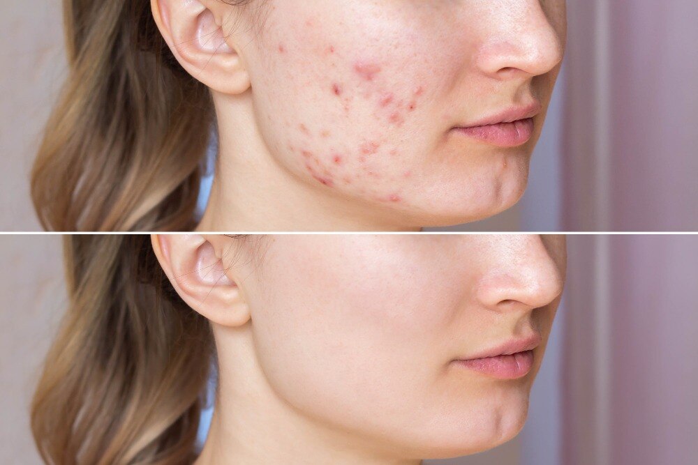 Is Acne Treatment in New Panvel Worth Considering