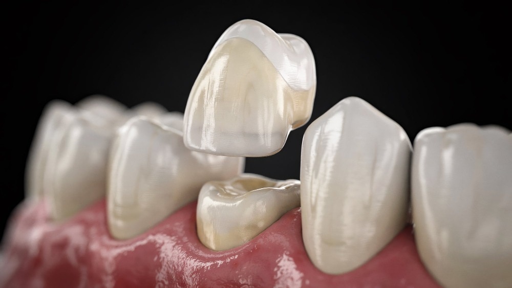 Crowns or Bridges Which Option Suits Your Smile in Kalyan