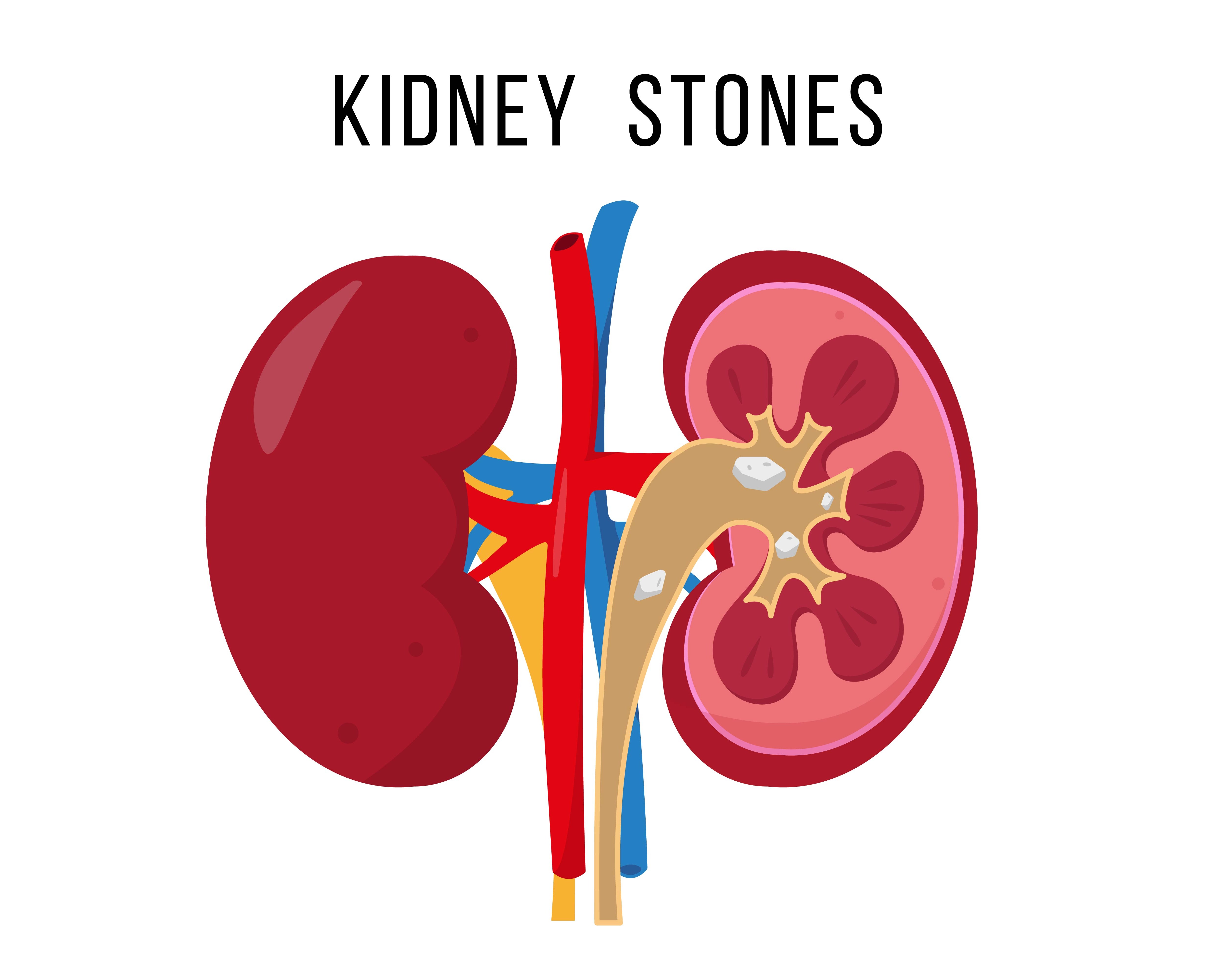 Kidney Stone in Manpada Symptoms, Testing, Treatment Decisions