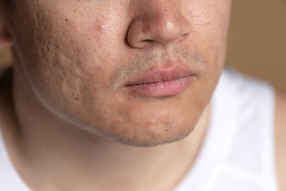 Is Acne Scar Treatment Worth It for Ageing Skin