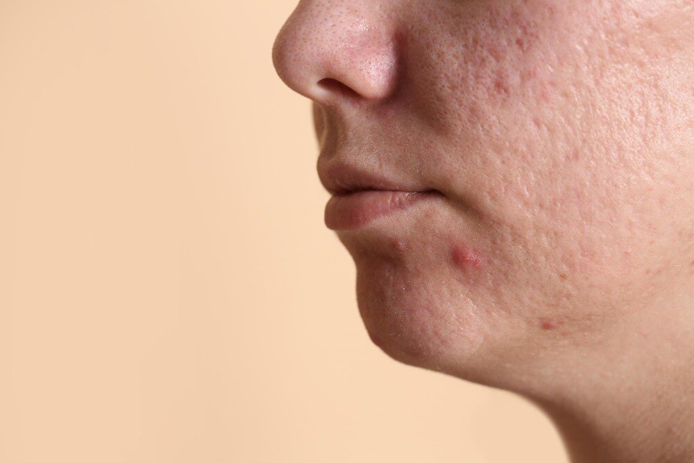 Who Needs Acne and Acne Scar Treatment in Belapur