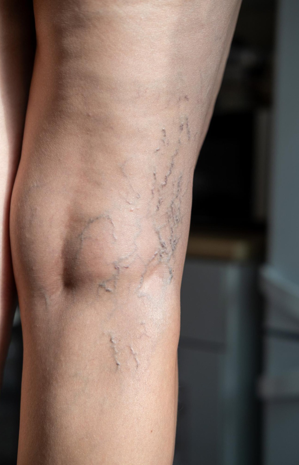 When Leg Veins Become More Than Cosmetic Understanding Varicose Veins Symptoms