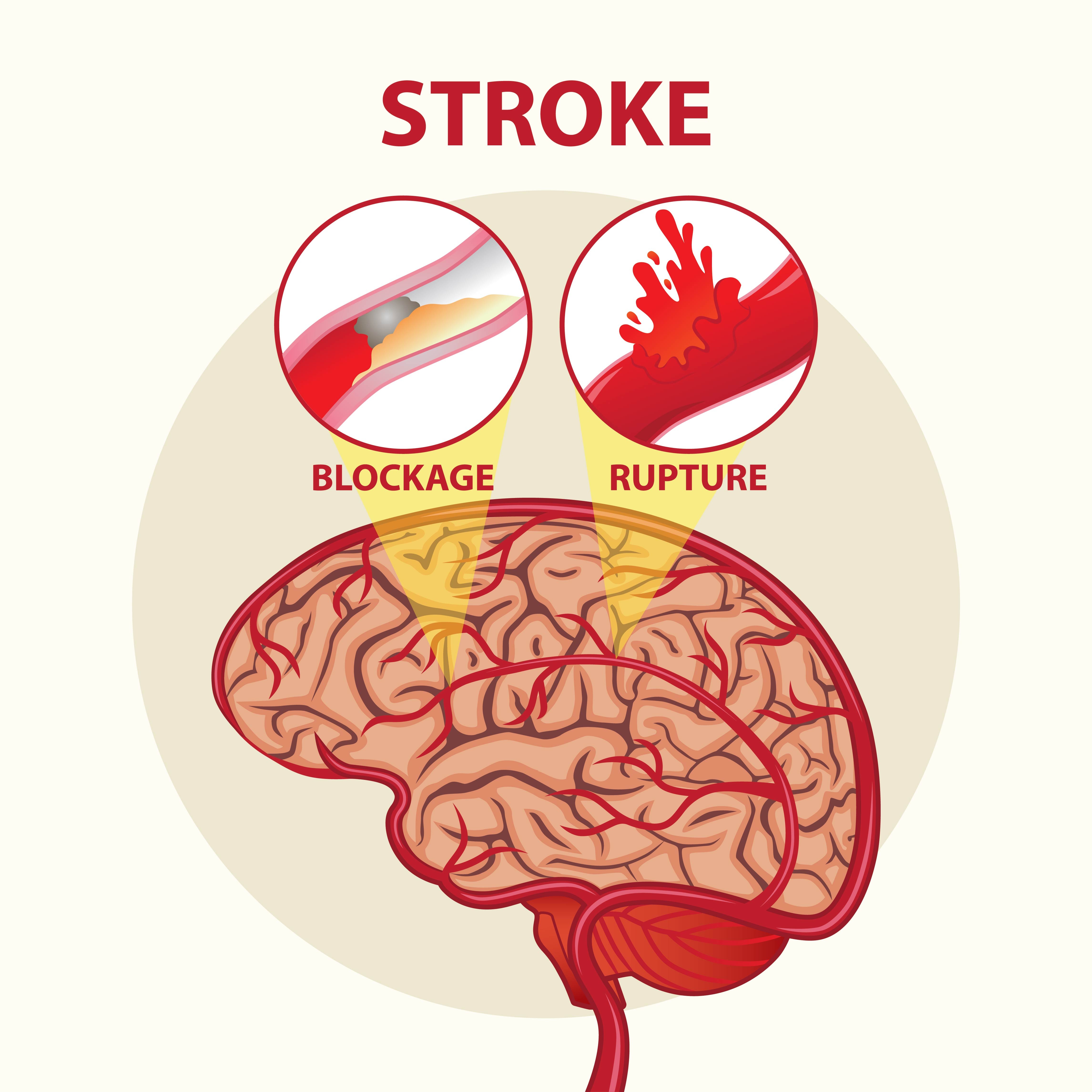 Why Timely Stroke Treatment Can Influence Recovery and Future Independence