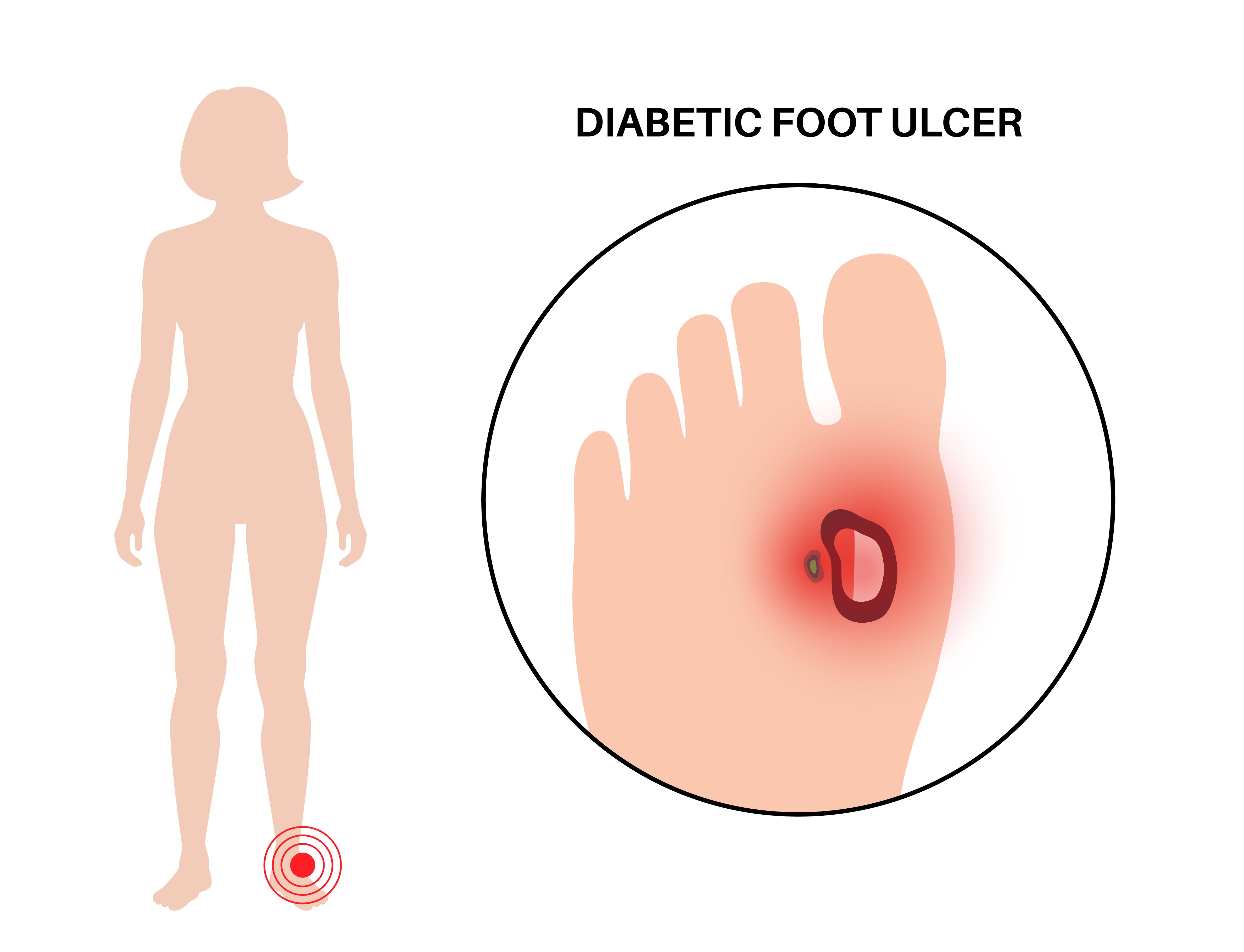 Diabetic Foot Ulcer Care and Warning Signs That Need Prompt Attention