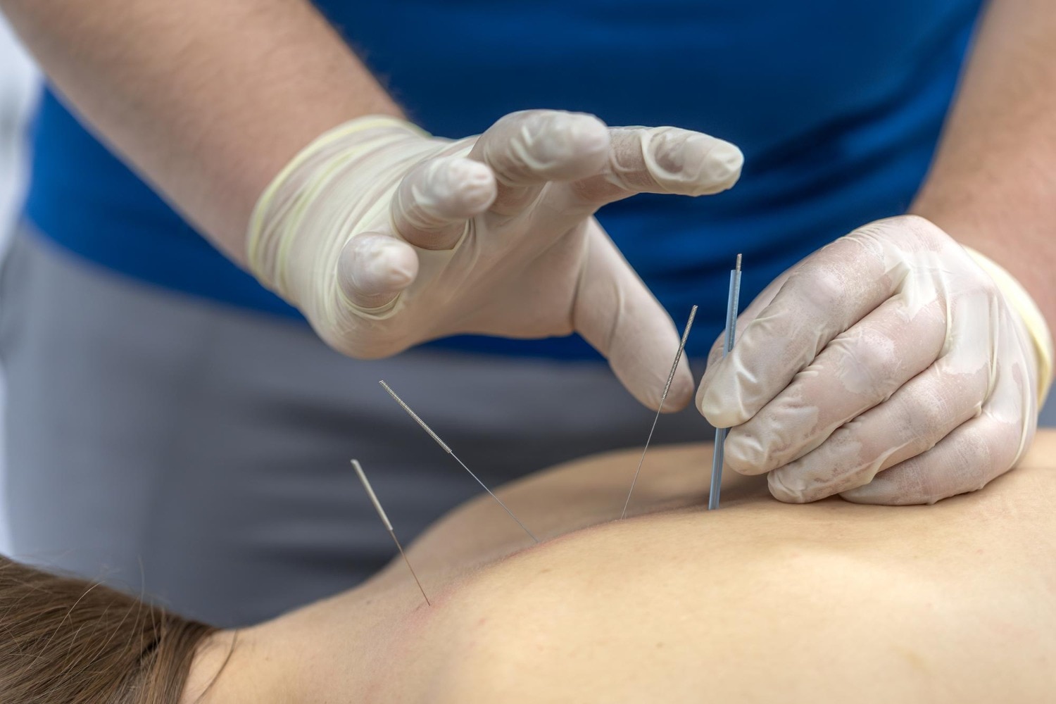 When Back Pain May Need Needling Therapy in Pune