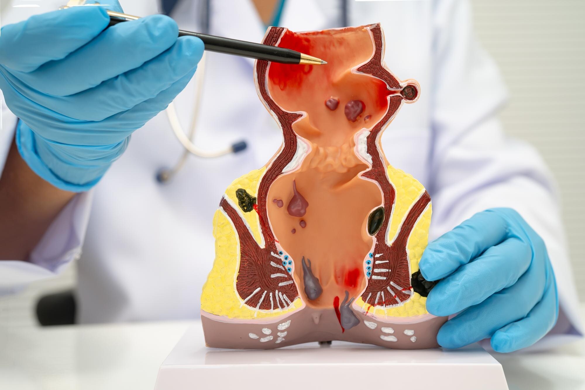 How a Lady Piles Doctor in Thane Evaluates Piles That Keep Returning