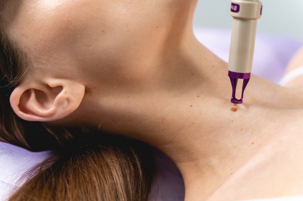 When Mole Removal Treatment Specialist Care May Be Recommended
