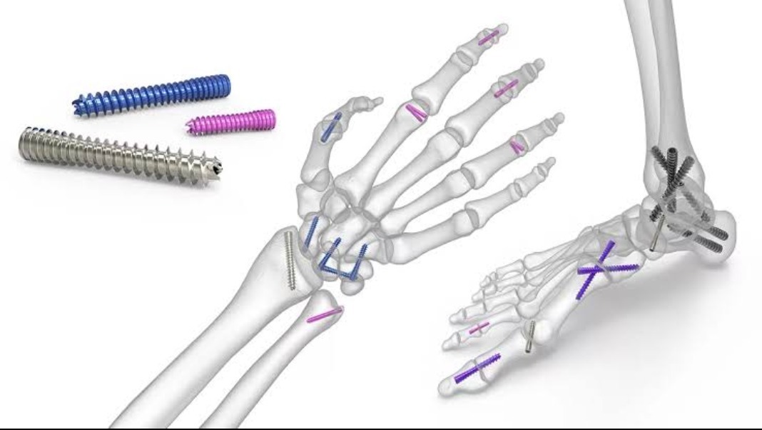 Endo Button Manufacturer In Gujarat