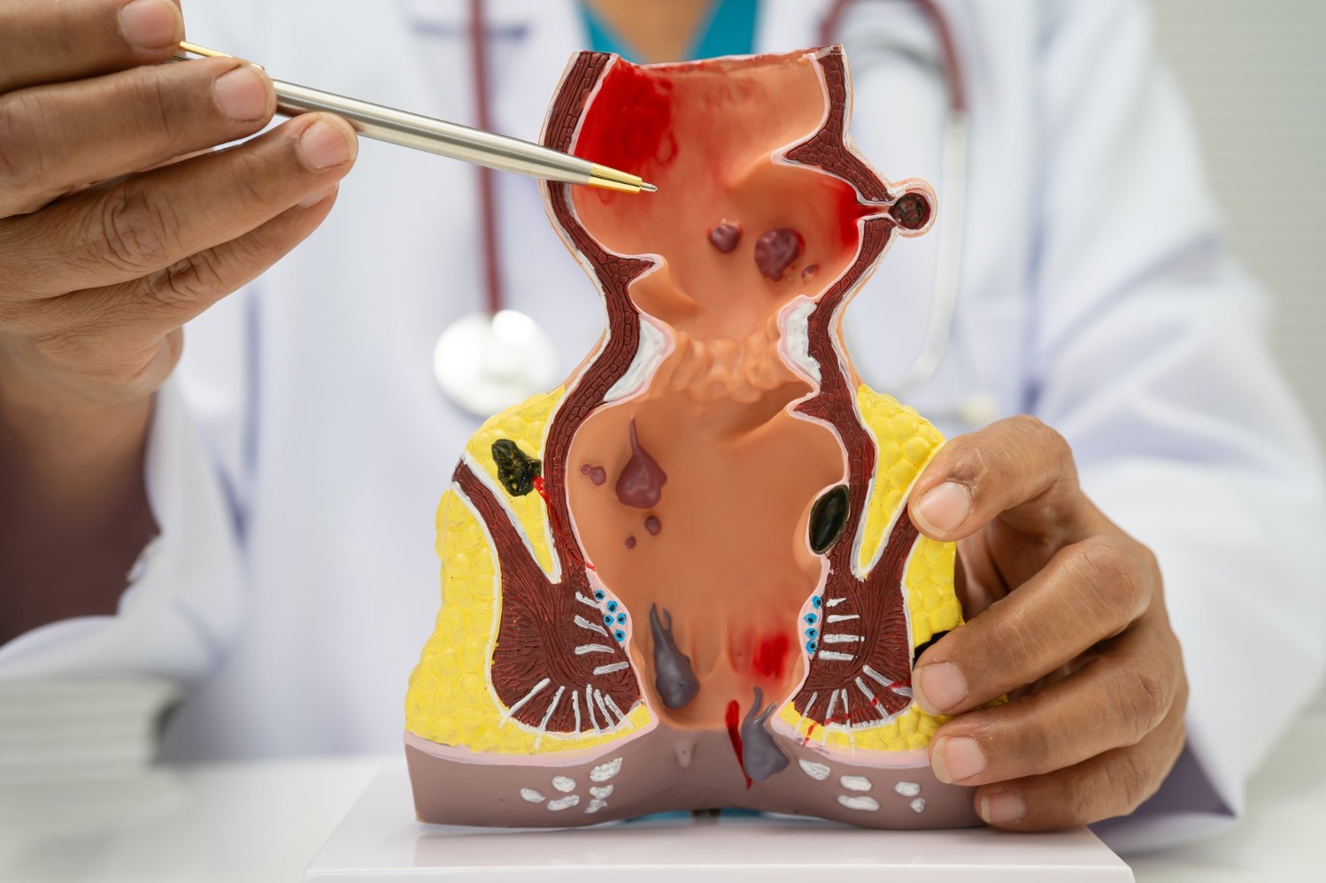 Recognising When Ayurvedic Treatment for Piles May Need Medical Assessment