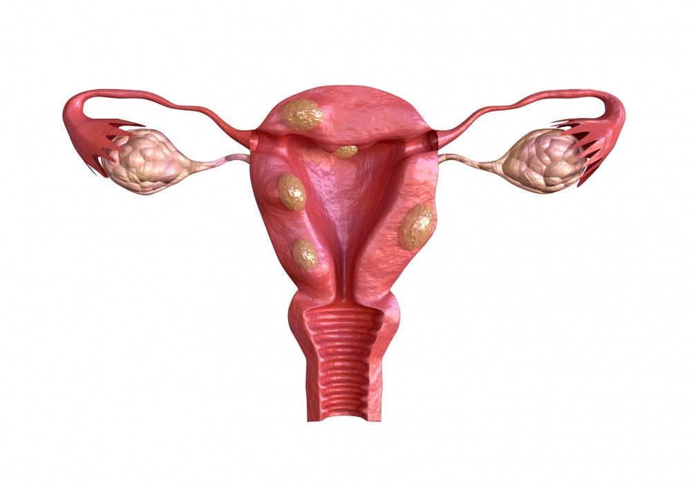 Fibroid Treatment Options Available in Thane for Different Fibroid Sizes