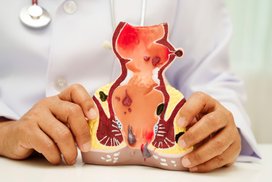 Laser Treatment for Piles with Quick Recovery in Navi Mumbai What Patients Should Know