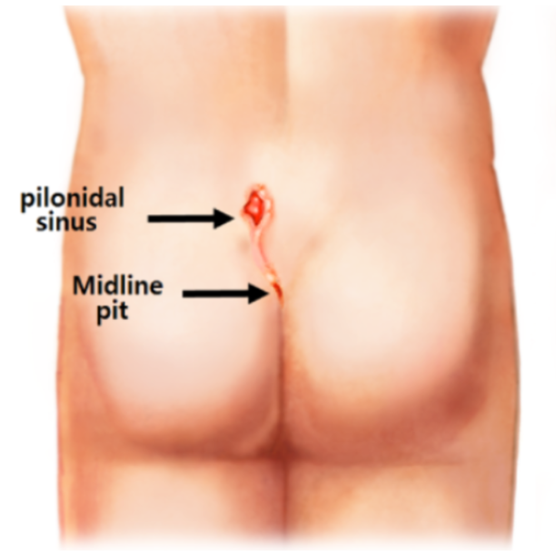 Pilonidal Sinus When Recurrent Swelling Needs Surgical Assessment