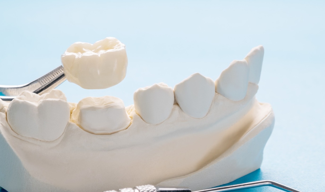 How Crowns and Bridges Restore Damaged Teeth and Missing Tooth Spaces