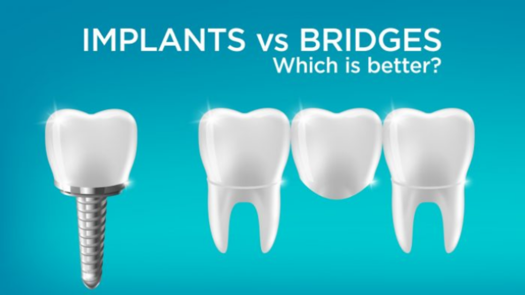 Dental Bridge vs Dental Implant: Which Is Better for a Missing Tooth?