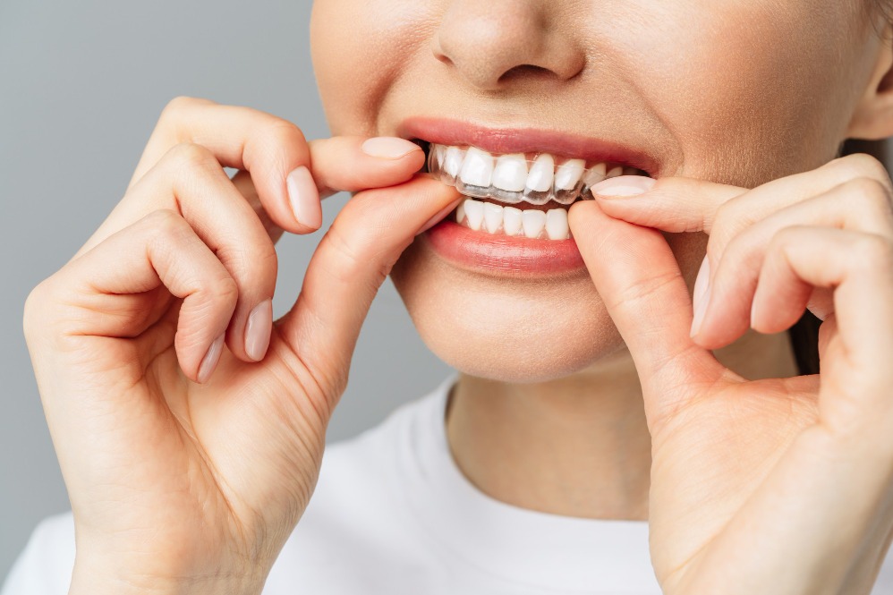 Clear Aligners Clinic in Dwarka Checklist for Choosing the Right Provider