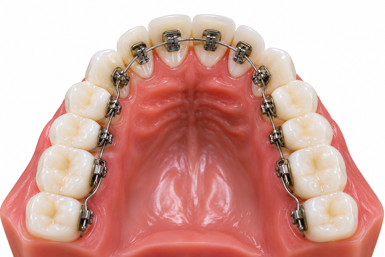 Lingual Braces Treatment in Kasarvadavali, Thane West for Adults Seeking a Less Visible Option
