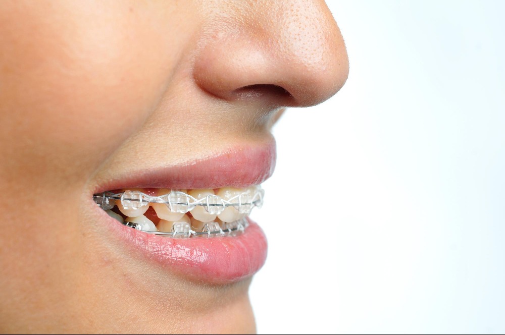 Ceramic Braces Treatment in Hiranandani Estate, Thane West and What to Check Before Choosing a Provi