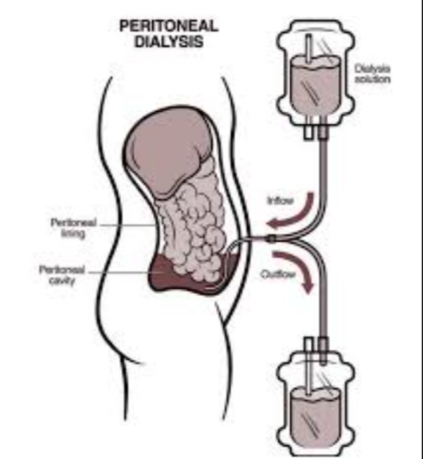 Peritoneal Dialysis or Hemodialysis Which Option May Fit a Patient’s Needs?