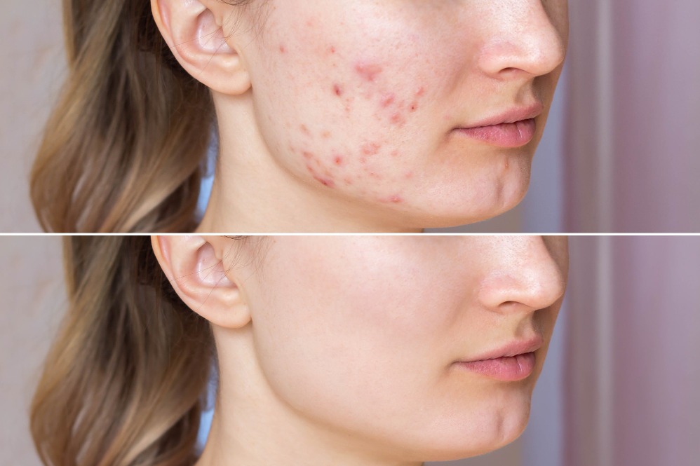 Acne Treatment in Mumbai: Choosing Between Creams, Medicines, Peels and Procedures