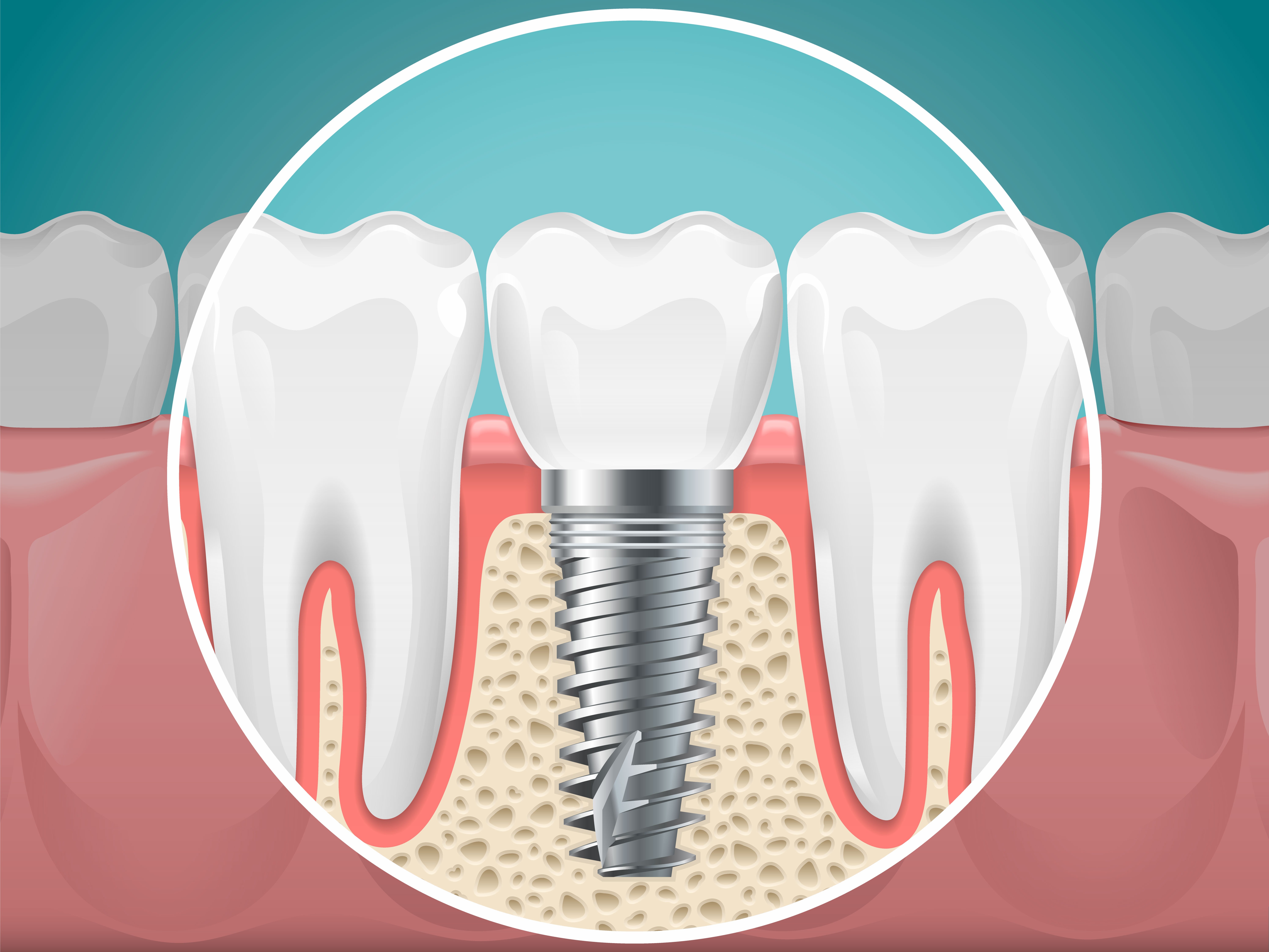 Implant Dentistry in Mumbai Provider Selection Guide