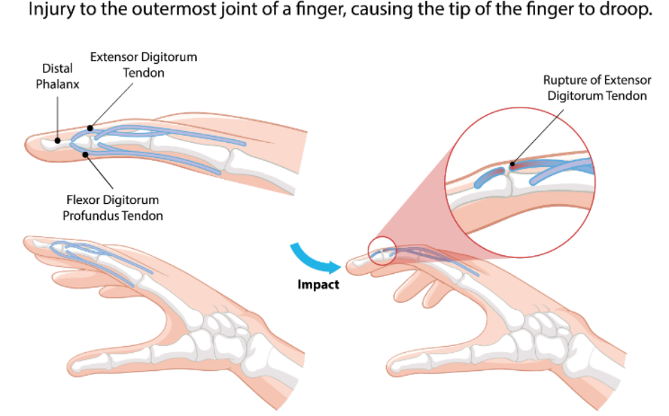 When Is Wrist and Hand Deformity Correction Surgery Considered in Lalbaug?