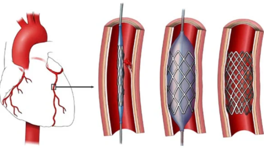 Coronary Angioplasty Evaluation What Patients Should Understand Before Treatment