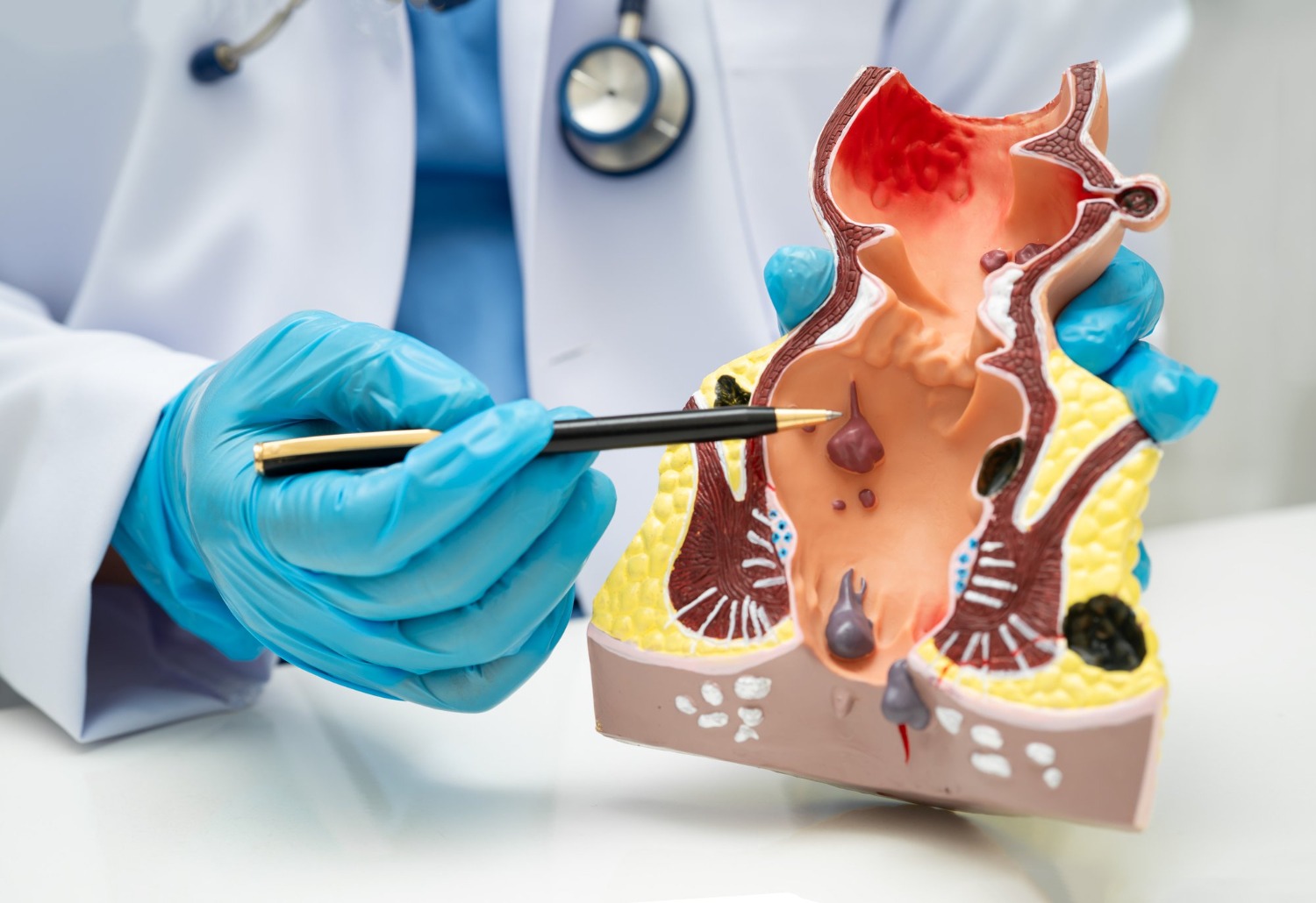 Laser Piles Surgery Hospital in Dhankawadi/Katraj/Bibwewadi/Kondhwa/Undri/Wanowrie/Swargate/Pune