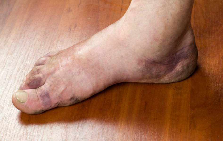 Swelling in Legs in Pokhran Road 1 When Kidney Function Should Be Checked