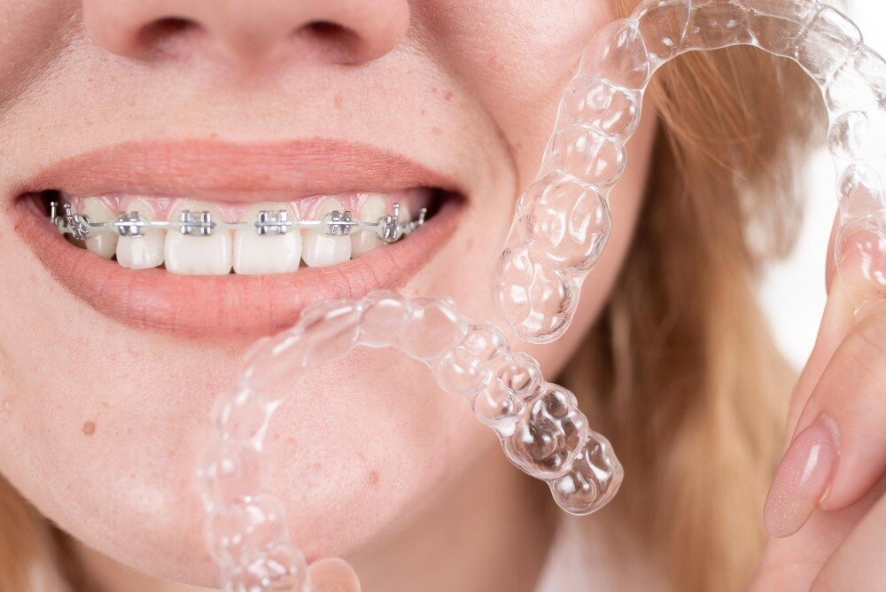 Clear Aligners or Braces for Adults in Hinjewadi