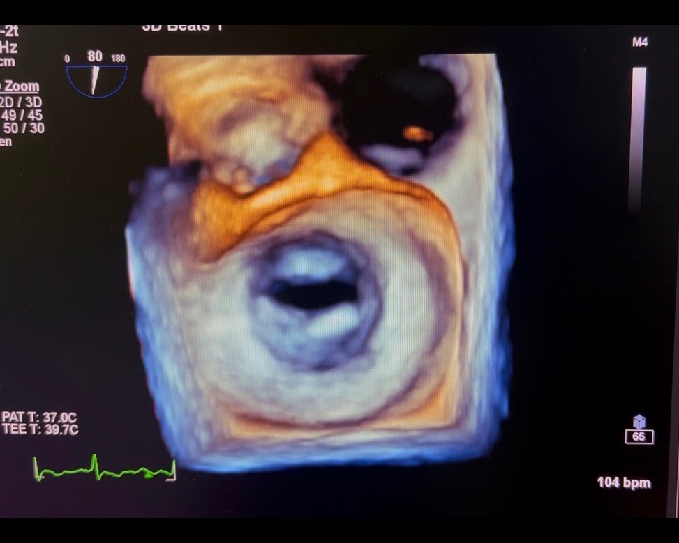 Why Is an Echocardiogram Important for Heart Health?
