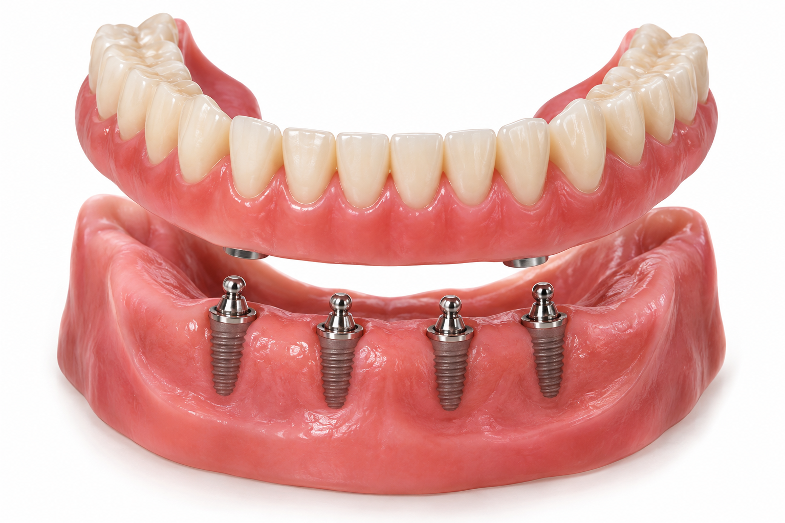 When Implant Overdentures Can Improve Denture Stability