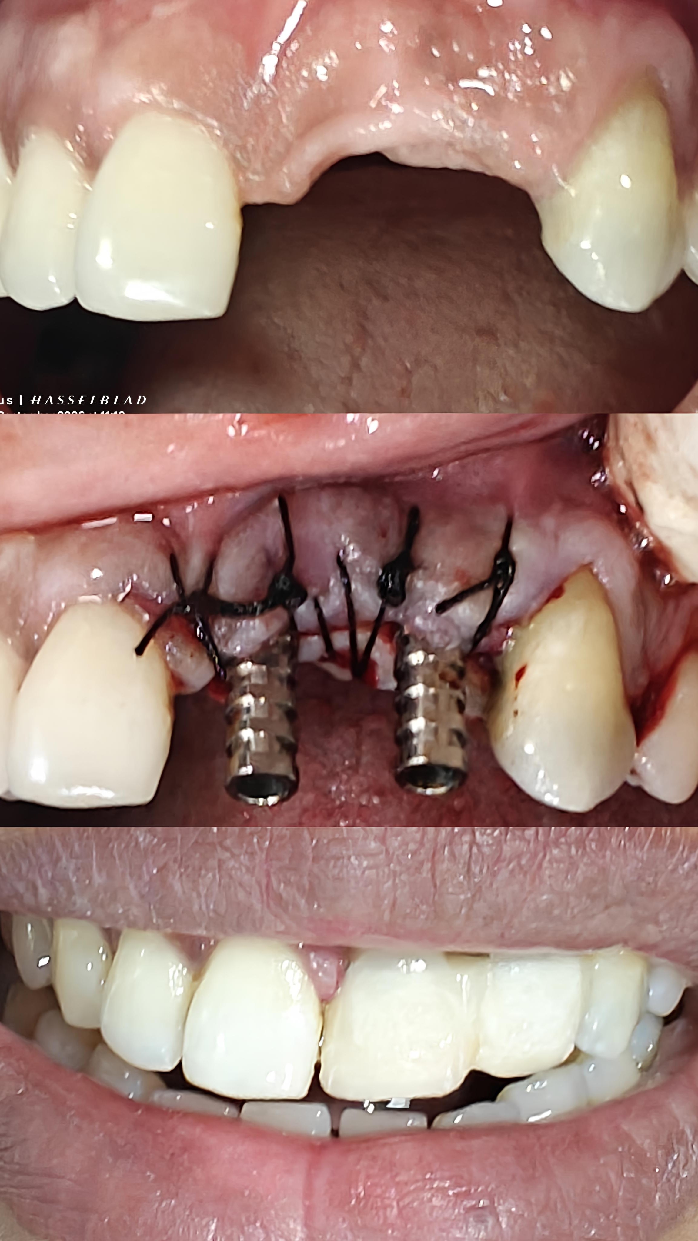 Best implants near me main image
