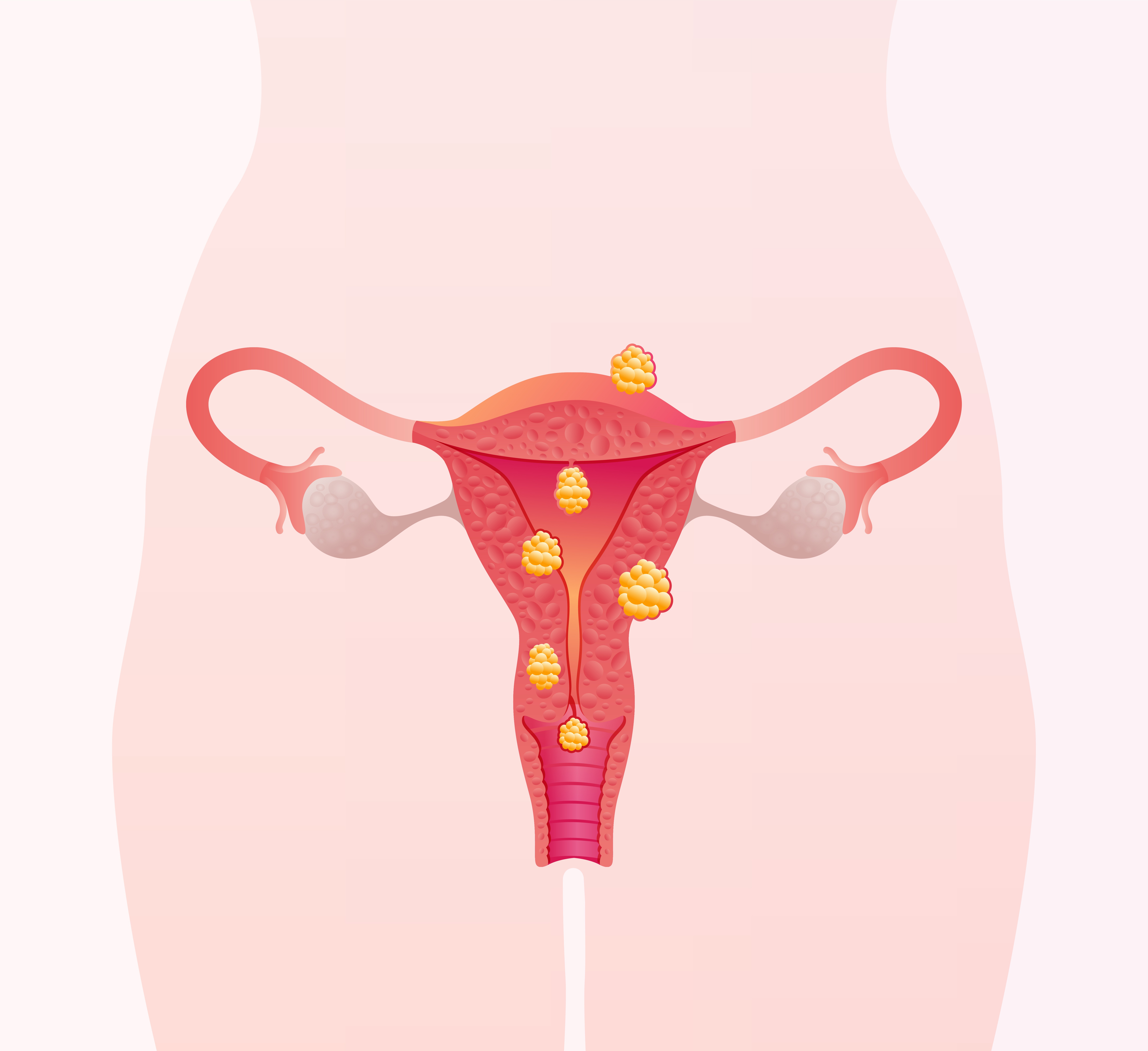 Managing Fibroids Through Personalized Hormonal and Metabolic Care
