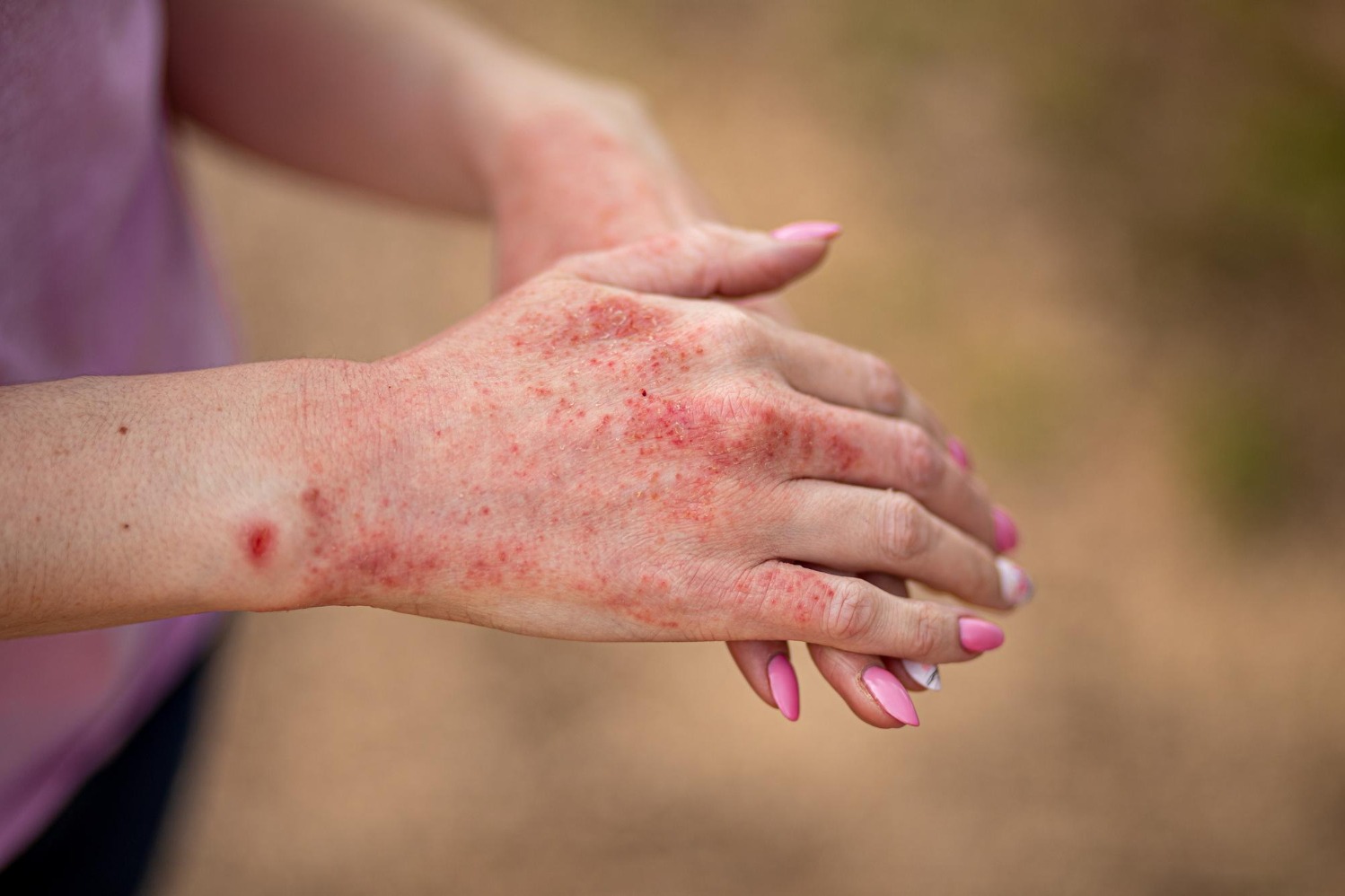 Why Recurrent Eczema Needs More Than Short Term Symptom Control