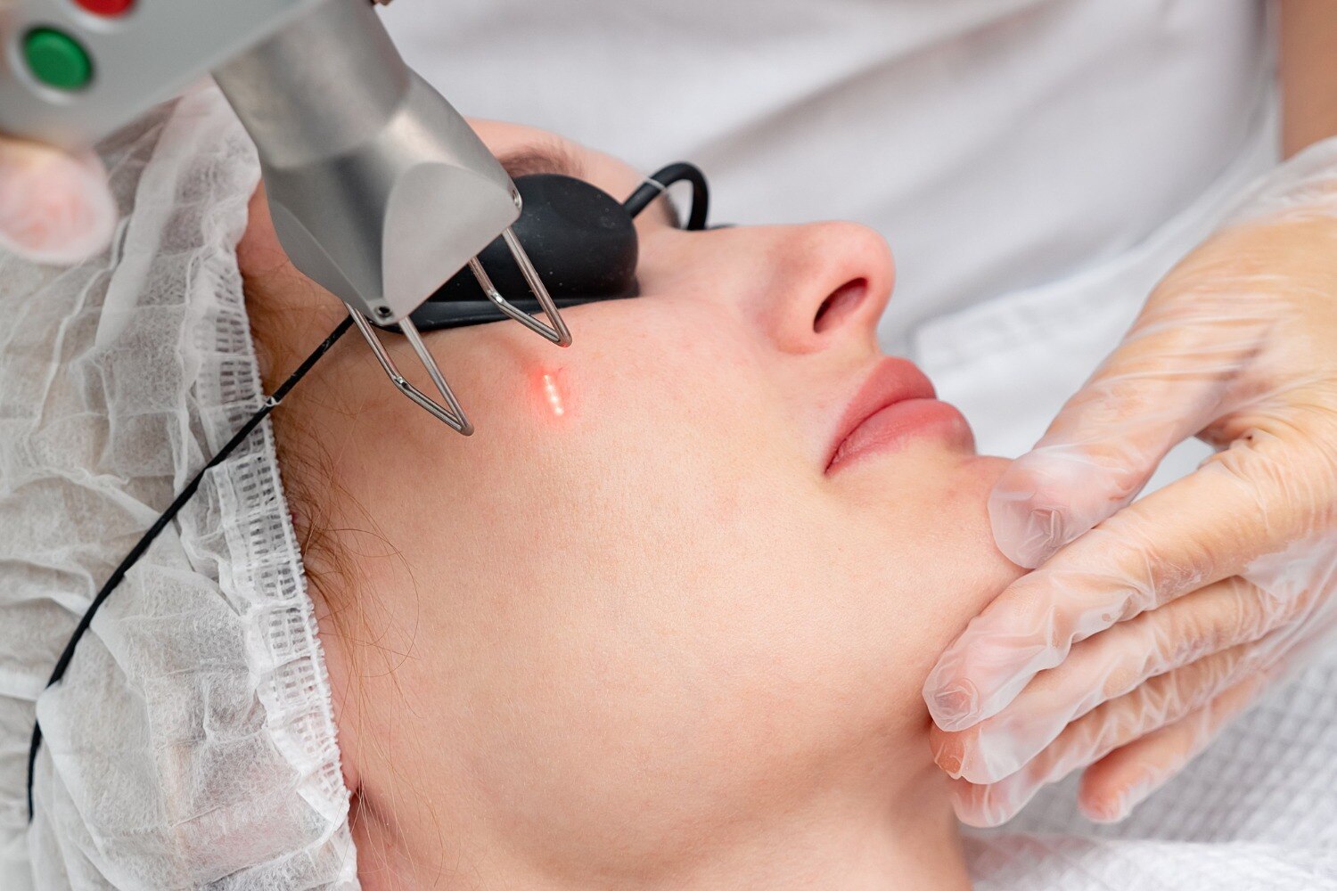 Q Switch Laser for Pigmentation: When Is It Recommended?