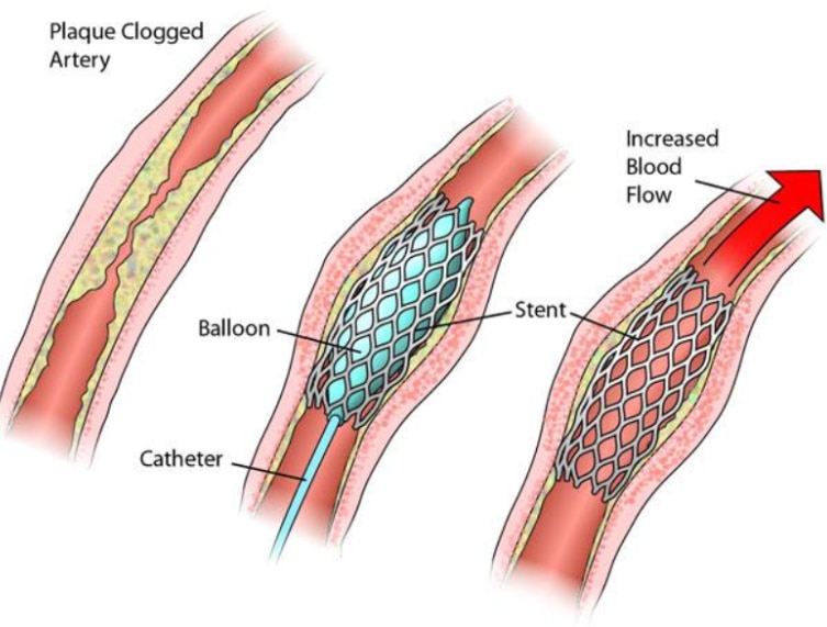 Angioplasty When Is It Considered for Blocked or Narrowed Heart Arteries