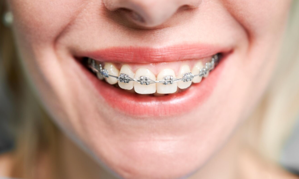 Orthodontic Treatment in Diva Thane: Braces, Aligners and Bite Correction Explained