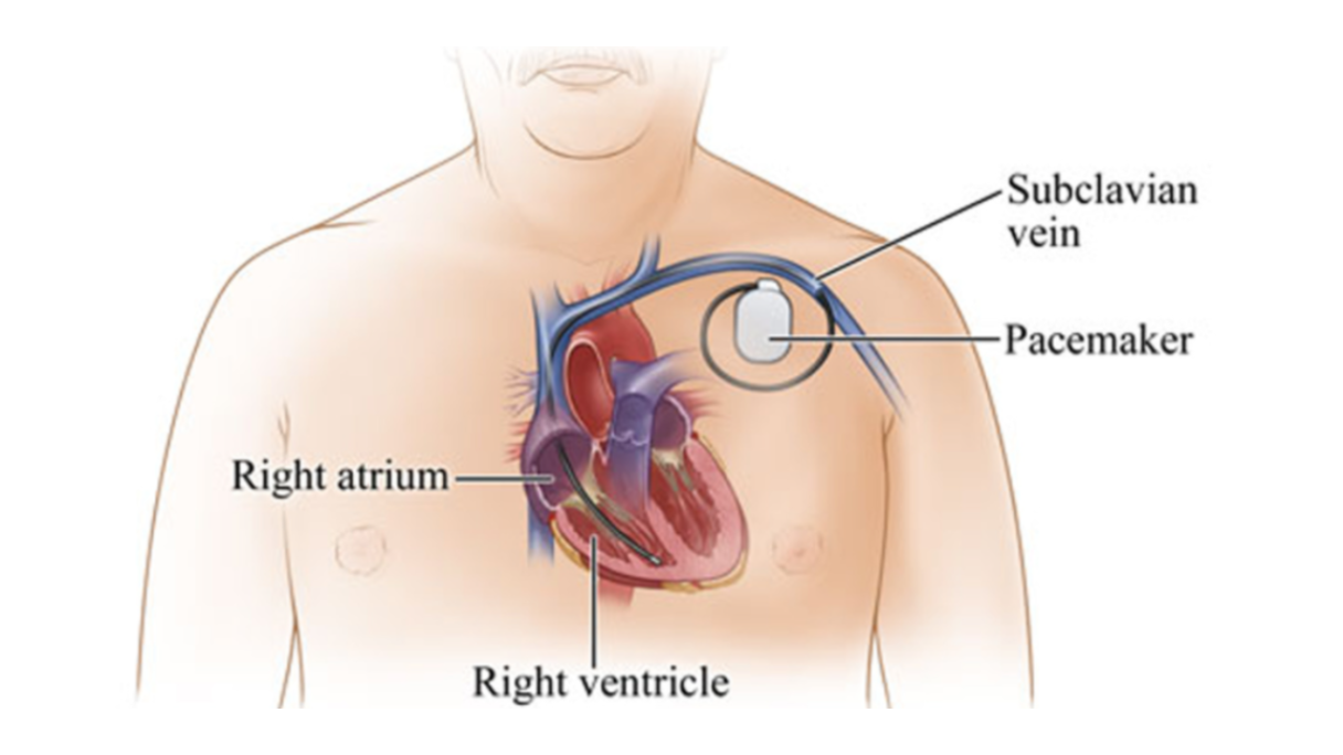 Temporary Pacemaker and Permanent Pacemaker Understanding Why the Choice Matters