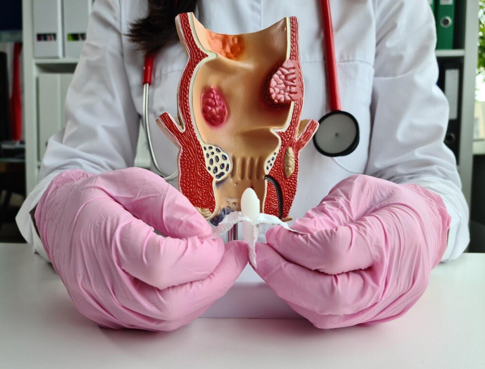 What Is Included Before and After Piles Surgery