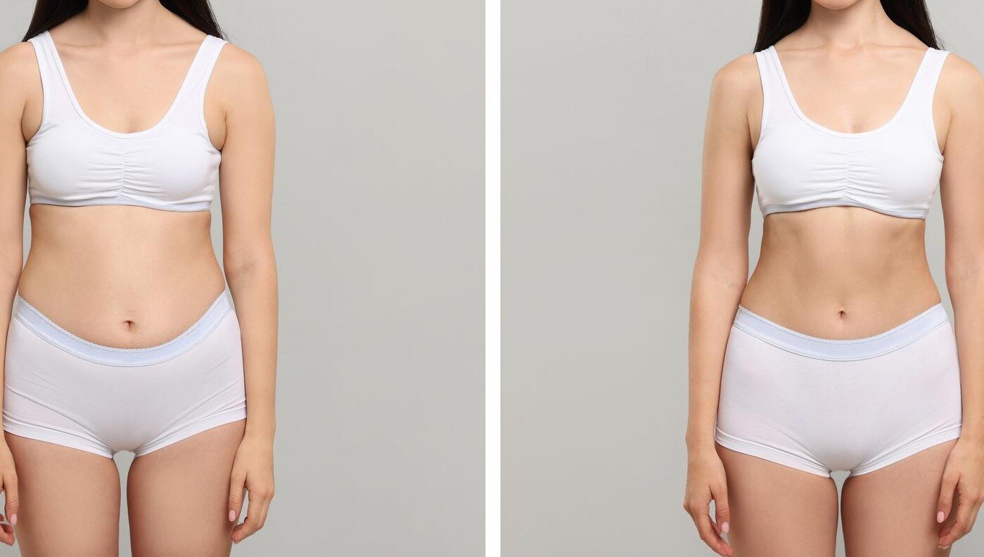 Loose Abdominal Skin After Weight Loss: When Can a Tummy Tuck Be Considered