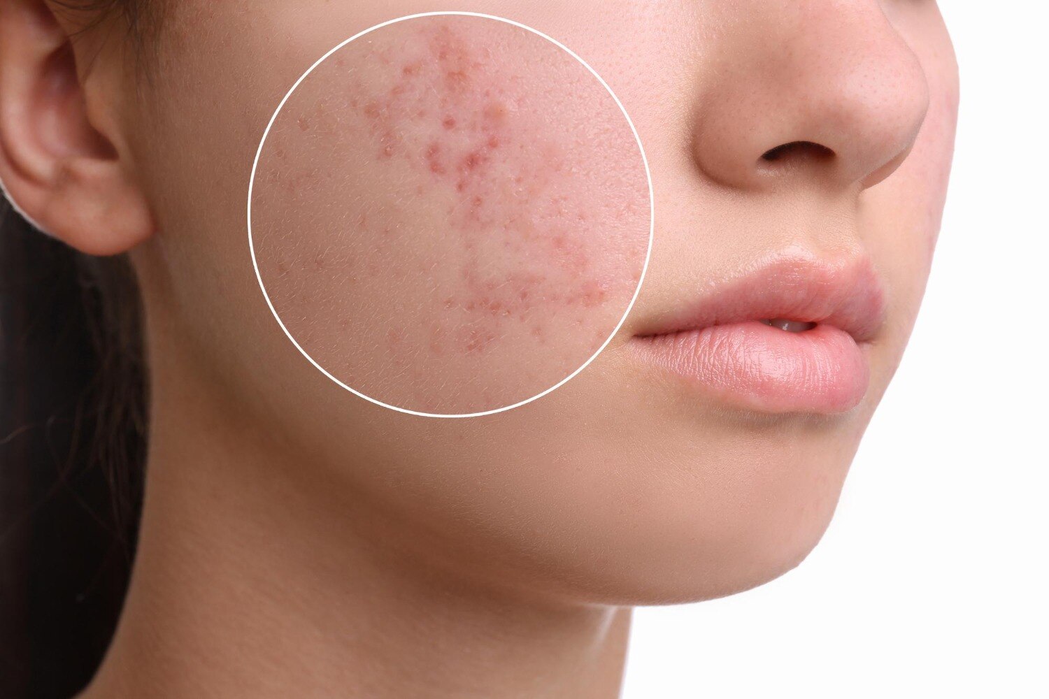 Acne Treatment for Recurring Breakouts Scars and Uneven Skin Texture