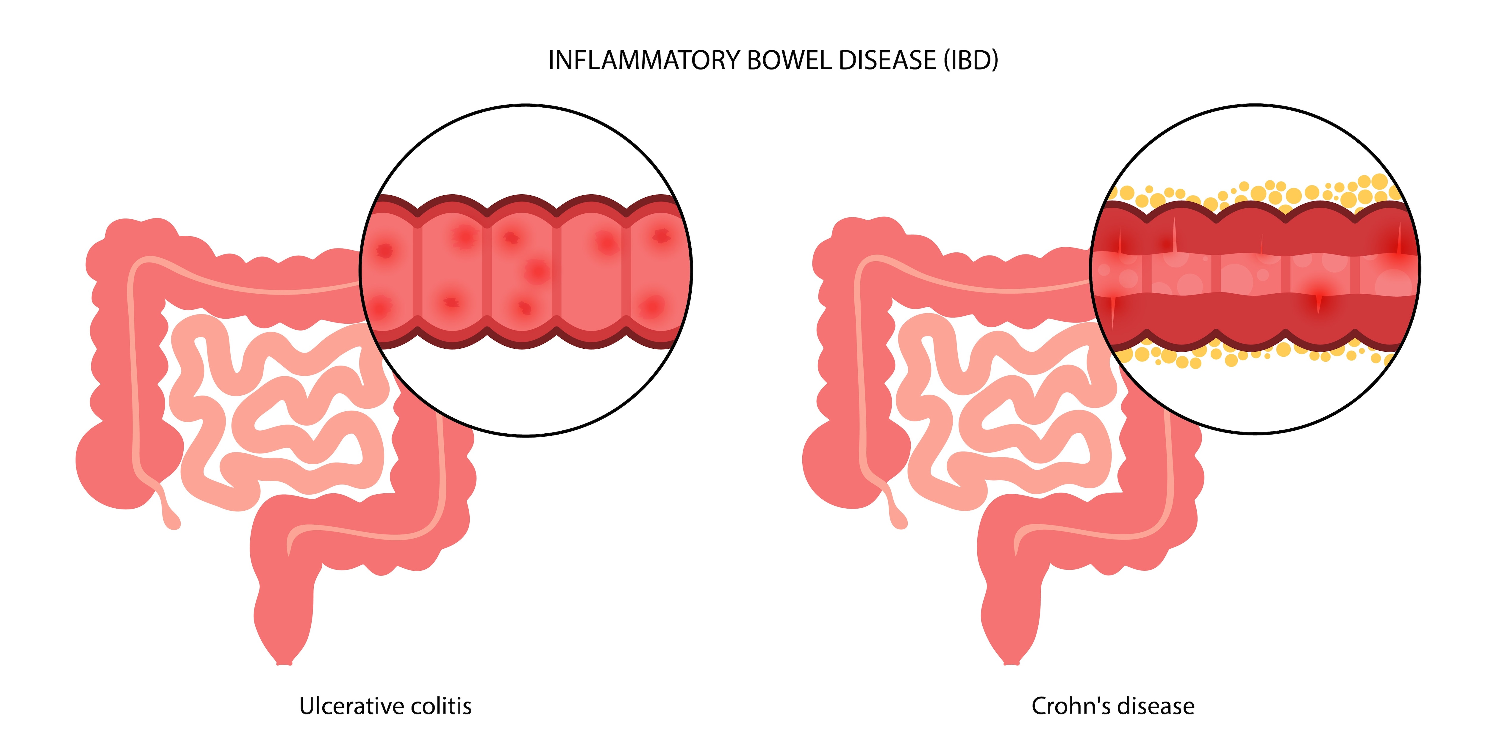 Inflammatory Bowel Disease IBD Symptoms and When Should You See a Gastroenterologist