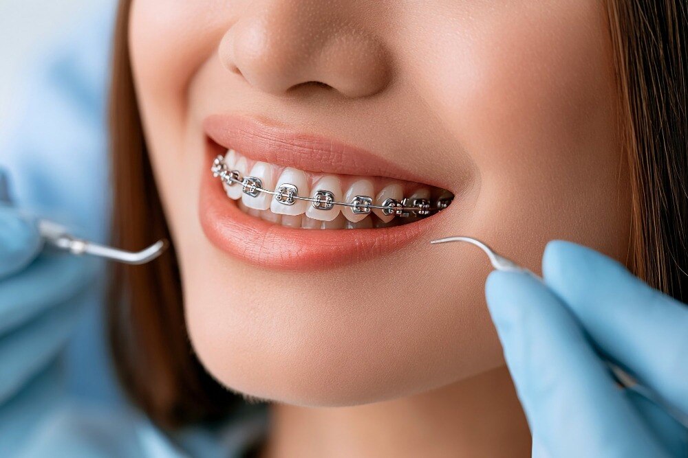 What to Expect When Getting Braces in Kammanahalli