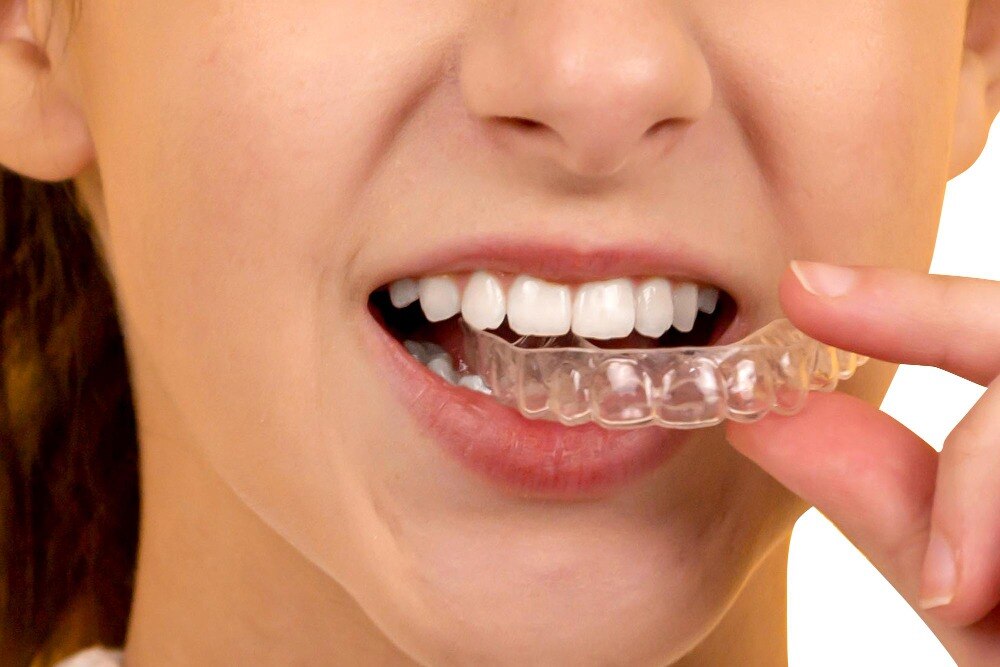 Are Clear Aligners Suitable for Working Adults in Kammanahalli