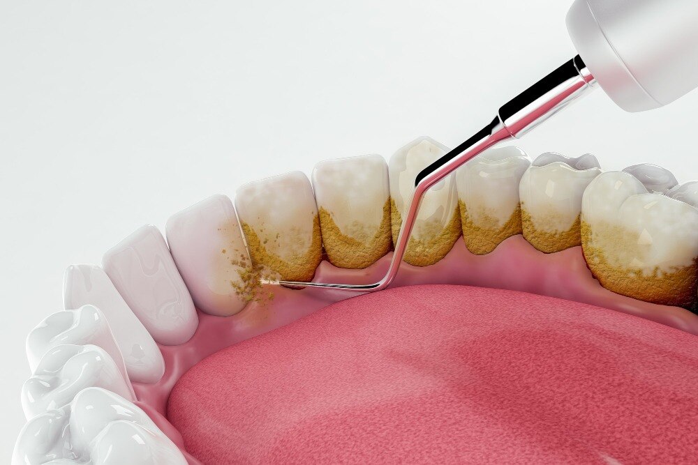 Which Scaling and Polishing Treatment Do You Need in Bangalore