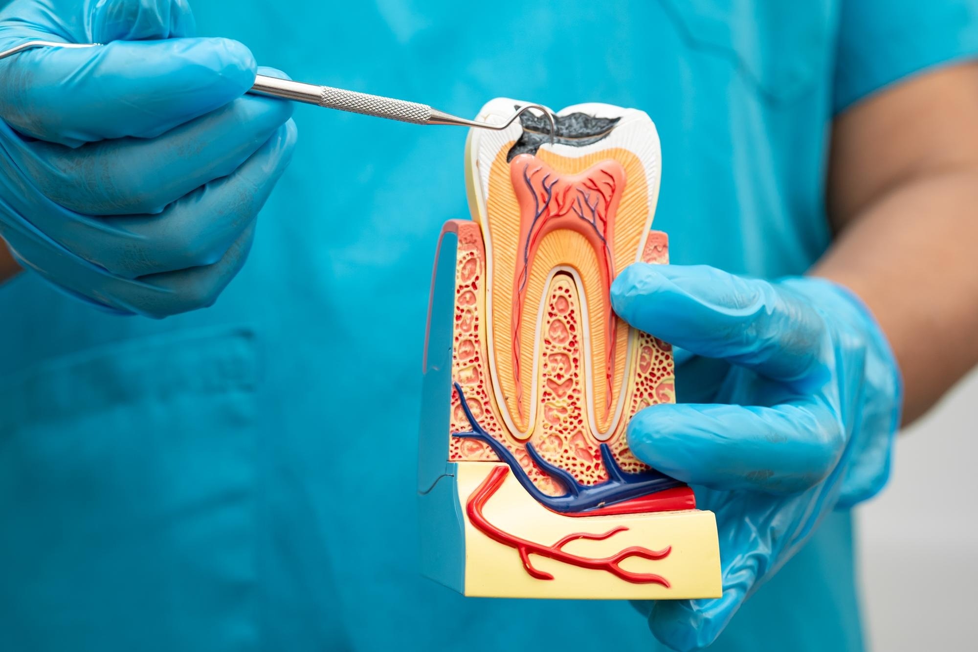 Best Root Canal Treatment for an Infected or Severely Damaged Tooth