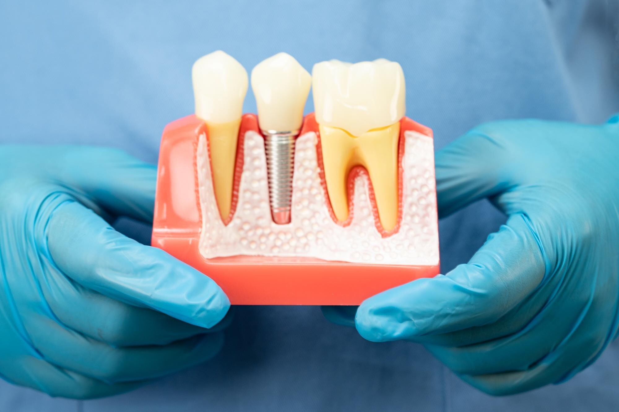Questions to Ask an Implant Specialist Before Dental Implant Treatment